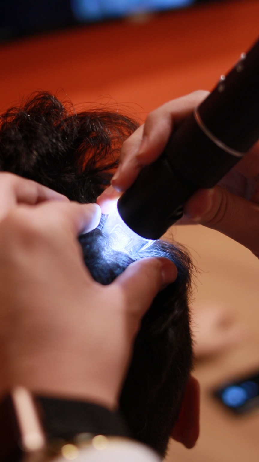 A queda de cabelo afeta milhões de pessoas ao redor do mundo, levando muitas delas a buscar soluções eficazes para recuperar os fios e a autoestima. Entre os procedimentos mais procurados, o transplante capilar se destaca como uma alternativa popular e de longa duração. Mas uma dúvida recorrente entre os pacientes é: o transplante capilar é definitivo?