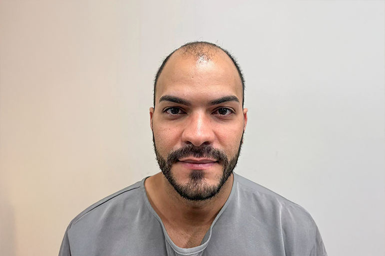 O transplante capilar é uma dos reparadores de danos mais eficazes e procuradas atualmente para quem sofre com a calvície ou queda acentuada de cabelo. Mas, para garantir resultados naturais, duradouros e com segurança, é essencial adotar uma série de cuidados antes e depois do procedimento. Neste conteúdo, desenvolvido especialmente para o blog da Fios Transplante Capilar, franquia com unidades em Brasília, São Paulo, Curitiba, Salvador e Fortaleza, vamos abordar os principais cuidados pré e pós-operatórios com base nas diretrizes médicas e científicas mais atualizadas, incluindo referências da Sociedade Brasileira de Dermatologia (SBD).