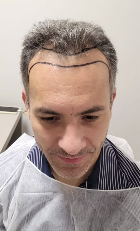 A dúvida é comum entre quem considera fazer um transplante capilar: o cabelo transplantado pode cair com o tempo? Essa pergunta gera insegurança, especialmente em homens que enfrentam a calvície e procuram uma solução definitiva. A boa notícia é que sim, o transplante capilar funciona e oferece resultados duradouros. Mas, atenção: manter o tratamento da alopecia androgenética é essencial para preservar os fios naturais e garantir o melhor resultado estético.