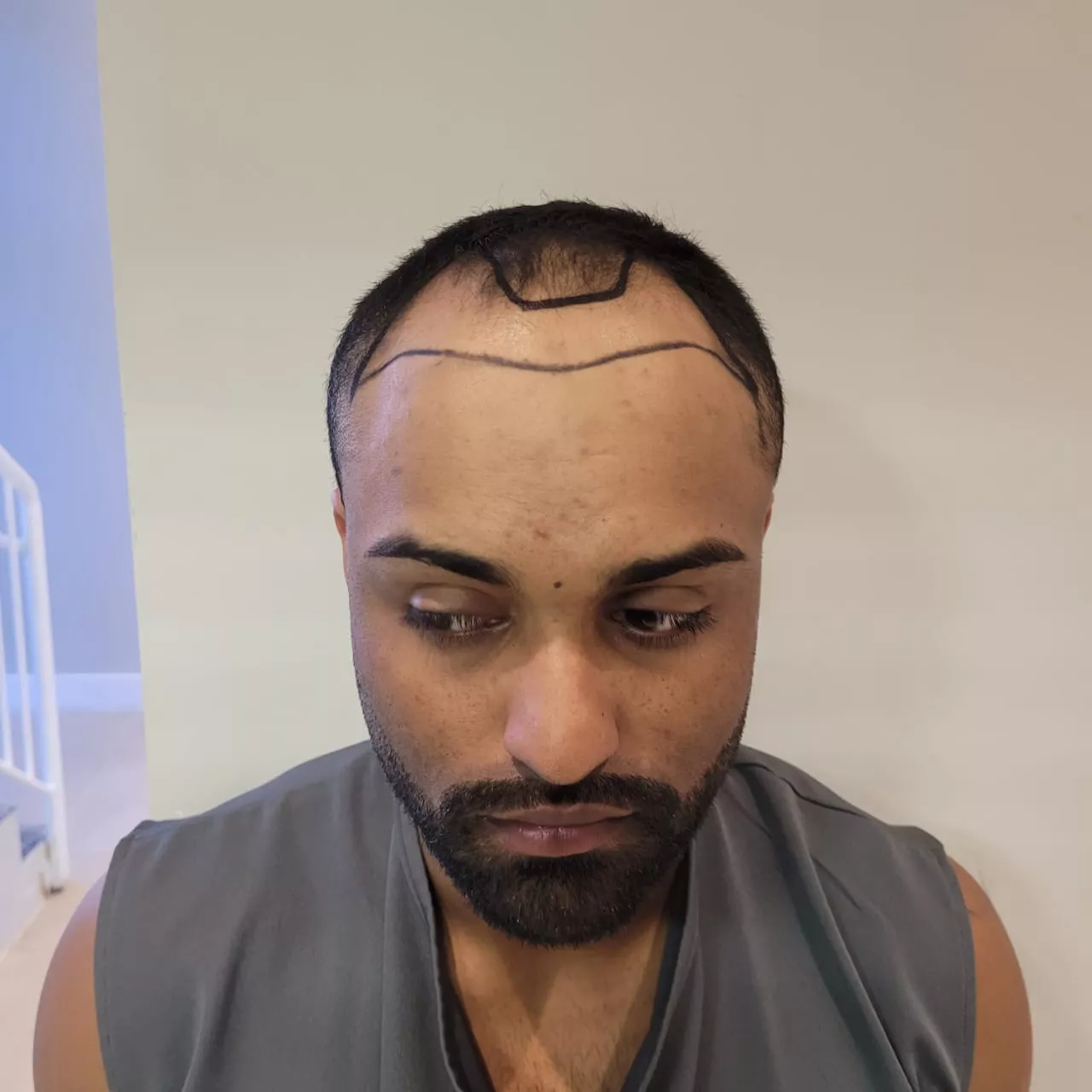 A busca por transplante capilar no Brasil cresceu mais de 250% nos últimos 11 anos, segundo dados da Associação Brasileira de Cirurgia da Restauração Capilar (ABCRC). Esse aumento expressivo coloca o país como uma das maiores potências mundiais em procedimentos de restauração capilar, ficando lado a lado com potências como a Turquia e os Estados Unidos.