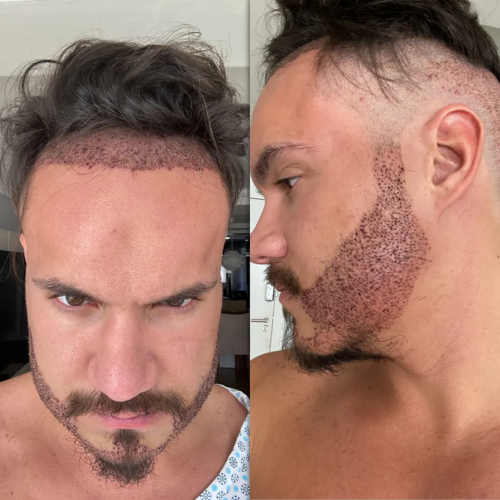 Nos últimos anos, o transplante capilar deixou de ser um tabu e se tornou uma opção viável e eficaz para homens que desejam recuperar a autoestima e a confiança. Celebridades brasileiras têm sido pioneiras nesse movimento, mostrando que se cuidar é um sinal de autocuidado e não de vaidade excessiva. Entre eles, Eliezer, ex-participante do Big Brother Brasil, se destacou ao compartilhar publicamente sua experiência com o procedimento.