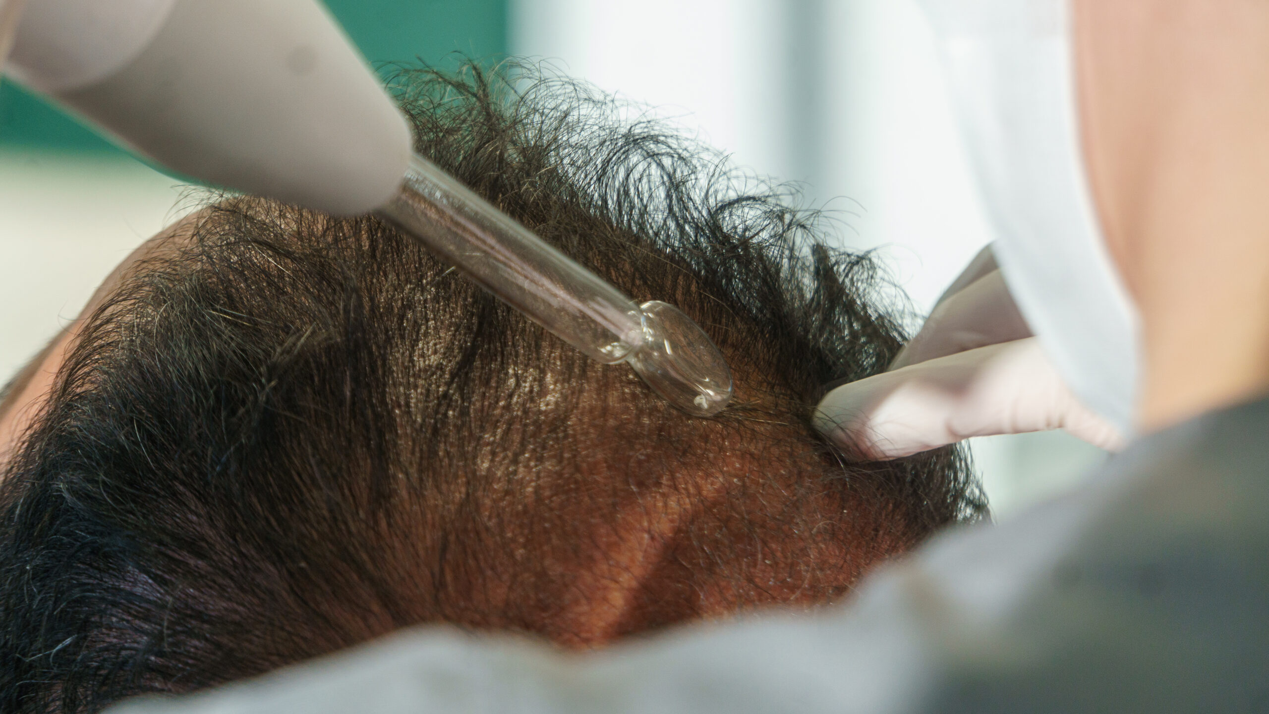 A restauração capilar se aproxima de um dos maiores saltos tecnológicos da sua história. A chegada de sistemas avançados de inteligência artificial integrados ao planejamento cirúrgico promete transformar a maneira como transplantes capilares são avaliados, executados e acompanhados. O movimento ganha força internacionalmente após o principal centro capilar da Turquia, localizado em Istambul, anunciar a implementação do primeiro sistema do país projetado para planejar transplantes capilares com inteligência artificial. Essa tecnologia, que chega de forma consolidada ao mercado internacional em 2026, estabelece um novo padrão global de precisão, personalização e previsibilidade.