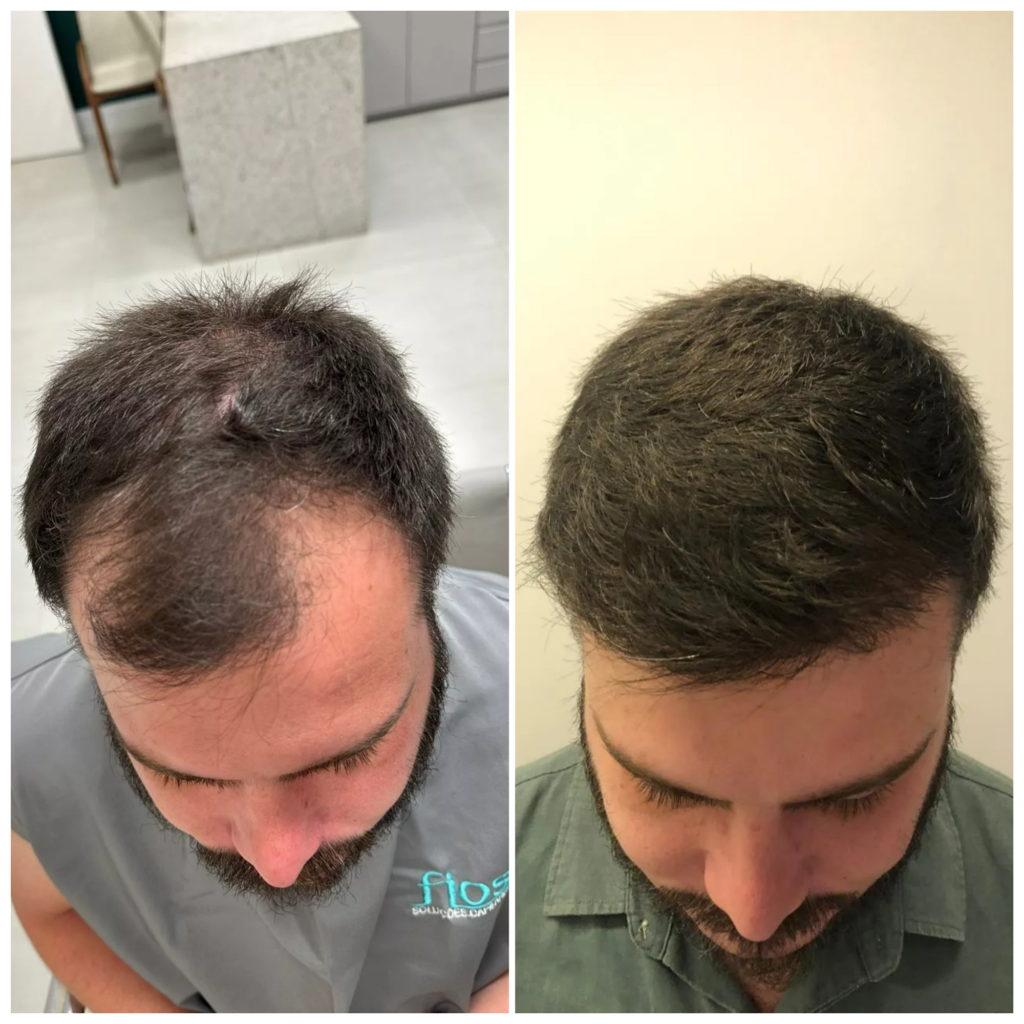 antes e depois